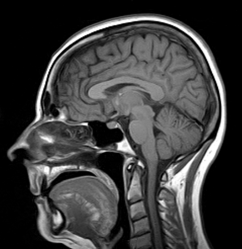 mri brain scan anatomy