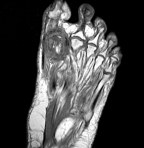 Foot MRI scan  Medserena Open MRI