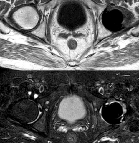 Upper Leg MRI scan  Medserena Open MRI