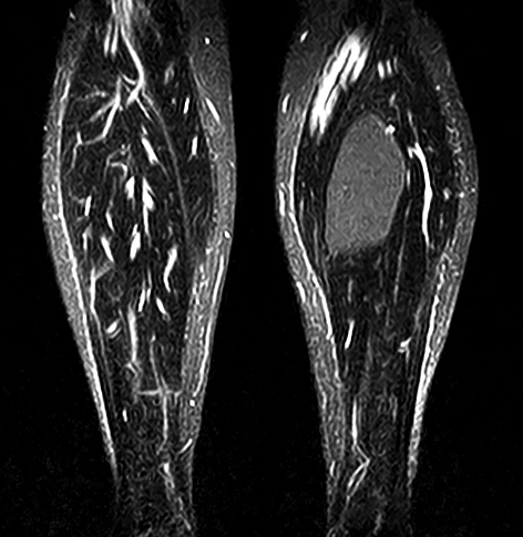 Comparison of MRI slices at the mid calf showing the anatomy with an IP