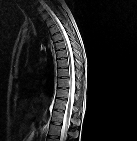 normal thoracic spine mri