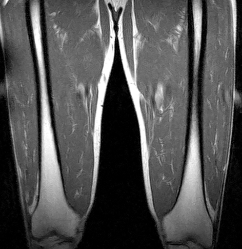 Upper Leg MRI scan  Medserena Open MRI