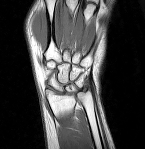 wrist ligaments mri